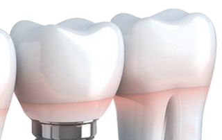 dental implants, bridges, and veneers