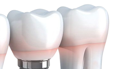 dental implants, bridges, and veneers