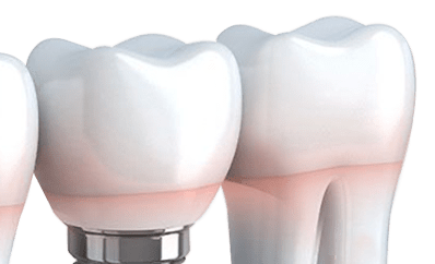 dental implants, bridges, and veneers