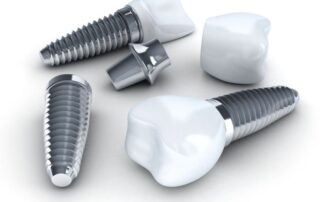 Dental Implants in Charleston SC