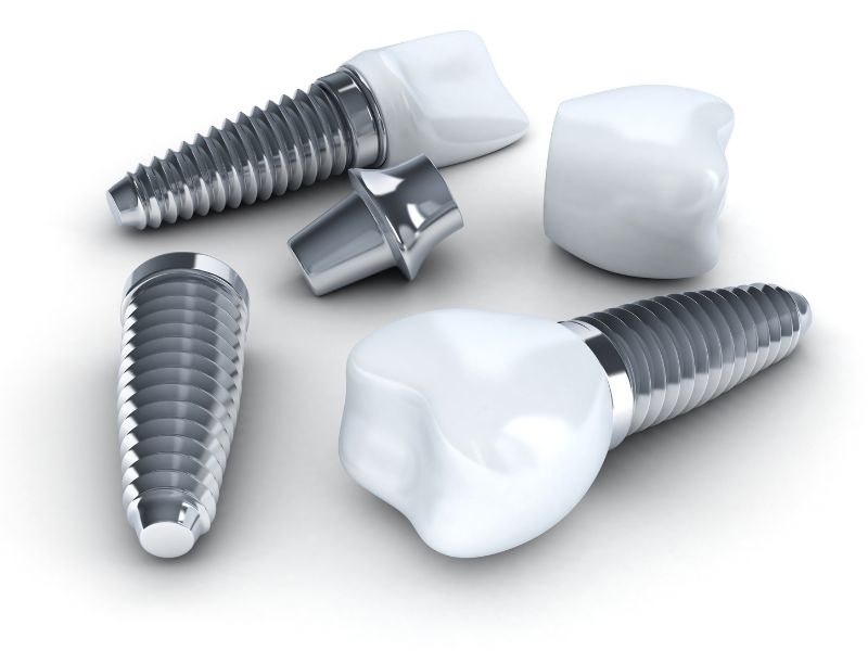 Dental Implants in Charleston SC