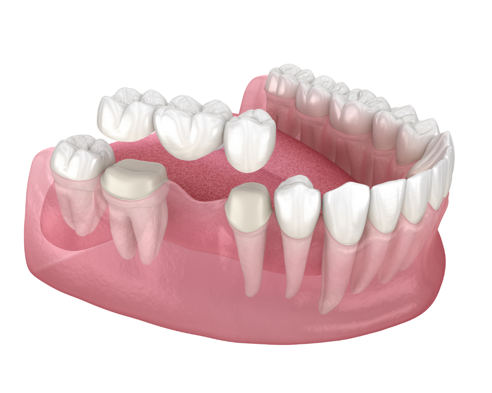 dental bridges charleston sc